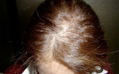 ¿Cómo evitar la caída del cabello rápidamente?