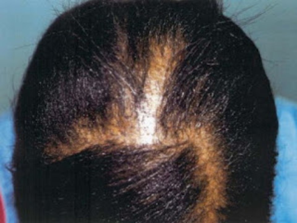 caida cabello9